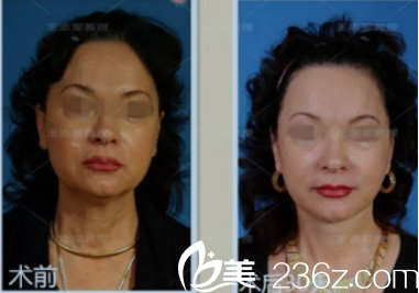 術(shù)后對(duì)比圖