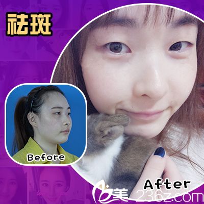 廣州美萊超皮秒全面部祛斑案例