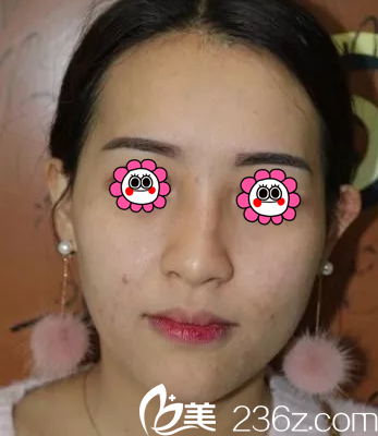 在北京惠合嘉美做自體脂肪面部填充前樣子 在北京惠合嘉美做自體脂肪面部填充前樣子