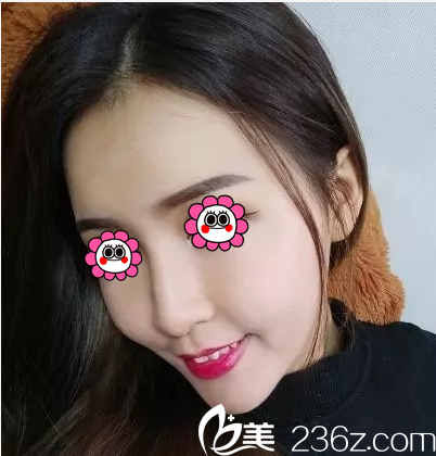 胡俊峰醫(yī)生給我做自體脂肪面部填充第17天效果 胡俊峰醫(yī)生給我做自體脂肪面部填充第17天效果