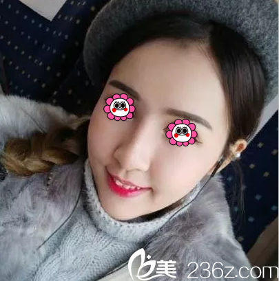 在北京惠合嘉美做自體脂肪面部填充第43天效果 在北京惠合嘉美做自體脂肪面部填充第43天效果