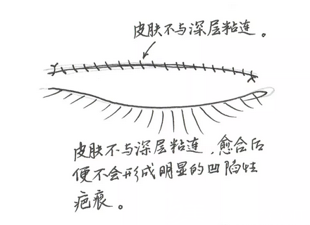 廣州博仕仿生理雙眼皮縫合特點(diǎn)