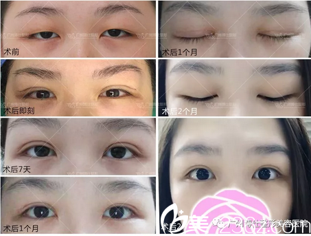 廣州博仕李帥敏仿生理雙眼皮案例圖