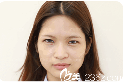 雙眼皮術前照片 雙眼皮術前照片