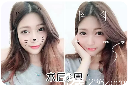 廣州美萊曾德淵雙眼皮案例 廣州美萊曾德淵雙眼皮案例