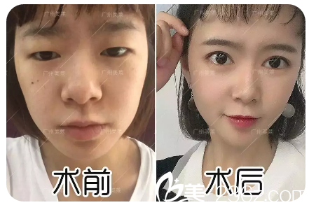 廣州美萊陳貴宗雙眼皮案例 廣州美萊陳貴宗雙眼皮案例