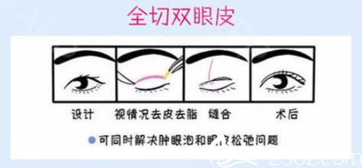 株洲華美全切雙眼皮的過程示意圖 株洲華美全切雙眼皮的過程示意圖