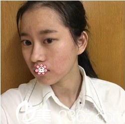 術(shù)前我大小眼 術(shù)前我大小眼