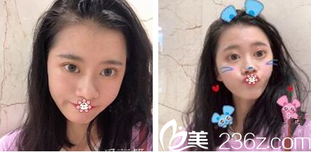 面診溝通時貴陽甲秀整形的醫(yī)生王靖說我的大小眼單眼皮割個全切雙眼皮就好啦 果然！