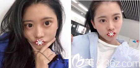 貴陽甲秀整形做雙眼皮怎么樣 貴陽甲秀整形做雙眼皮怎么樣