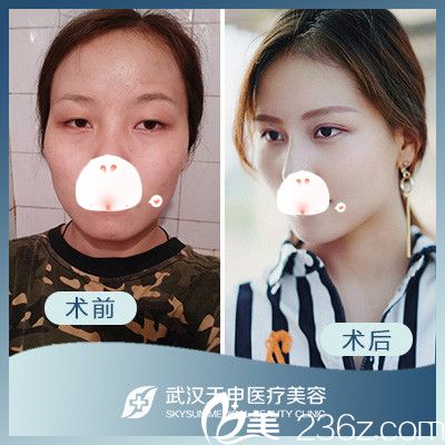 武漢天申整形雙眼皮前后對(duì)比案例