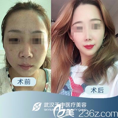 武漢天申整形假體隆鼻前后對(duì)比案例