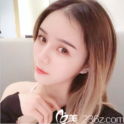 廣州曙光萬友望全臉脂肪填充案例 廣州曙光萬友望全臉脂肪填充案例