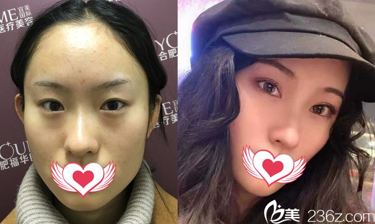 <!--<i data=20240703-sp></i>-->眼鼻綜合整形案例前后效果對(duì)比圖 <!--<i data=20240703-sp></i>-->眼鼻綜合整形案例前后效果對(duì)比圖