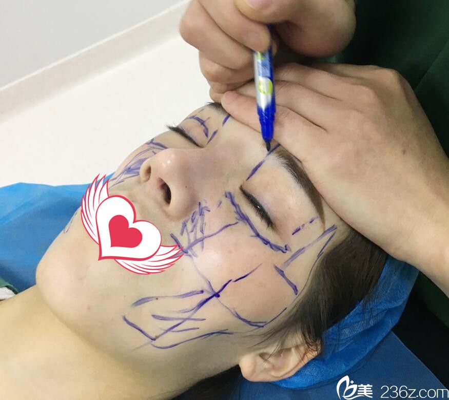 趙章杰自體脂肪全臉填充術(shù)前設(shè)計(jì)方案