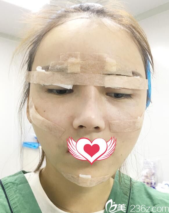 去合肥福華整形做面部填充自體脂肪即刻效果