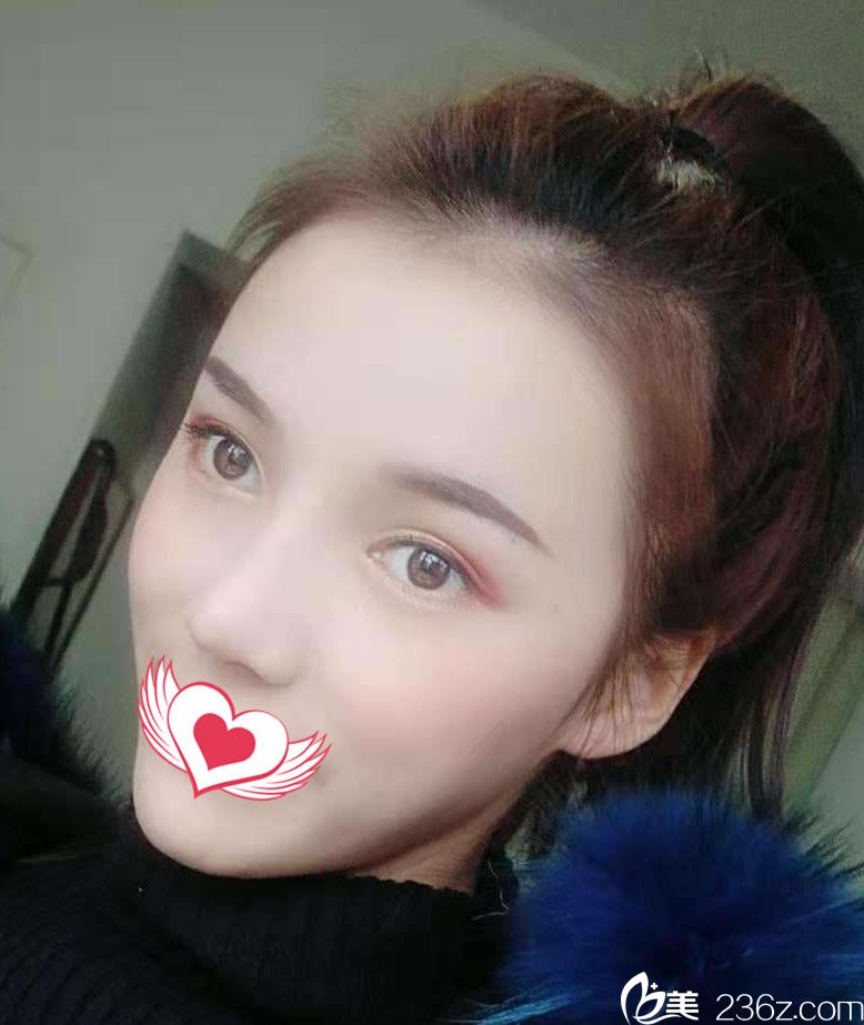 找趙章杰做眼鼻綜合+自體脂肪填充1個(gè)月效果圖