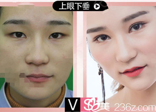 衡陽曹家眼部整形真人案例