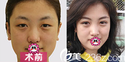 北京惠合嘉美無(wú)痕埋線雙眼皮案例