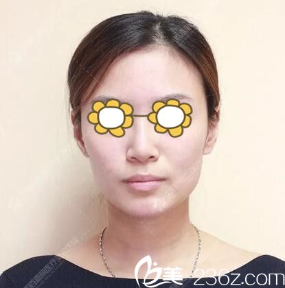 果酸換膚+玻尿酸面部填充+光子嫩膚術(shù)后效果 果酸換膚+玻尿酸面部填充+光子嫩膚術(shù)后效果