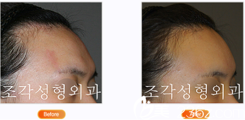 韓國雕刻整形醫(yī)院向后彎曲的額頭整形 韓國雕刻整形醫(yī)院向后彎曲的額頭整形