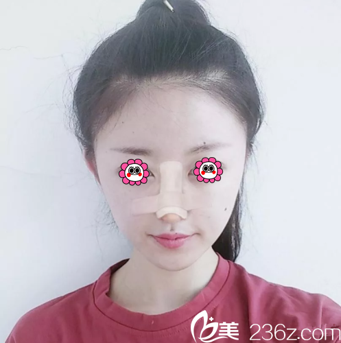 魏傳飛醫(yī)生鼻綜合手術(shù)案例