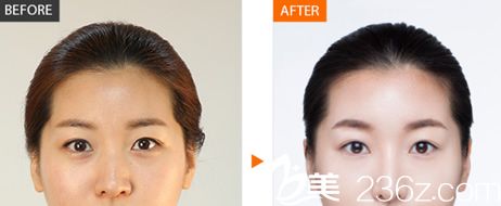 富陽(yáng)韓珈吳金峰雙眼皮隆鼻<span style= 富陽(yáng)韓珈吳金峰雙眼皮隆鼻<span style=