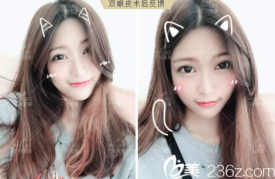 廣州美萊曾德淵雙眼皮案例