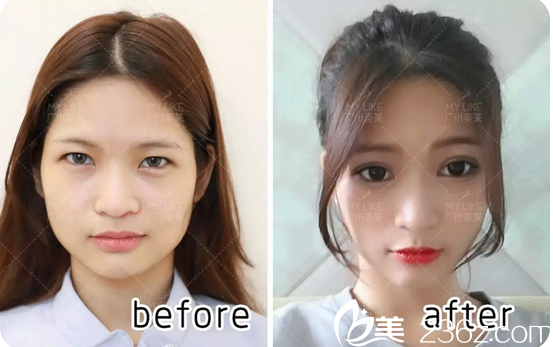 廣州美萊曾德淵做雙眼皮怎么樣