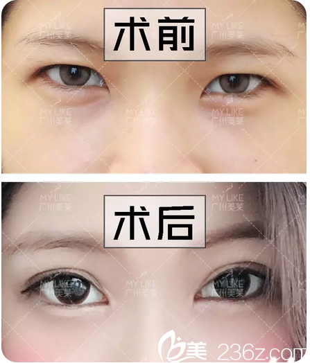 曾德淵雙眼皮案例術(shù)前術(shù)后對(duì)比
