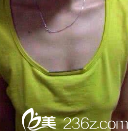 在煙臺做隆胸時候的術(shù)前照片 在煙臺做隆胸時候的術(shù)前照片