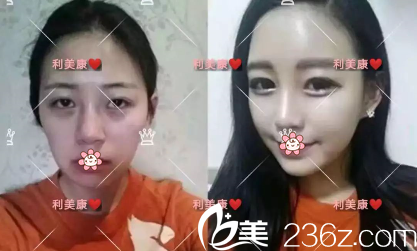 于建濤玻尿酸豐蘋果肌案例