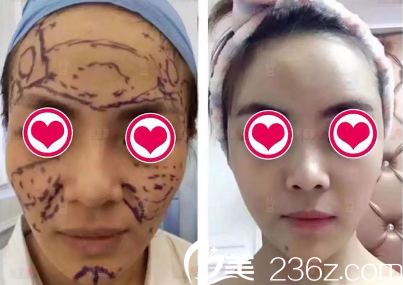 遵義利美康打玻尿酸效果怎么樣？玻尿酸豐蘋(píng)果肌太陽(yáng)穴等案例展示