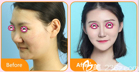 北京藝星整形隆鼻多少錢?BSK宮廷鼻綜合隆鼻價(jià)格表和案例搶先看