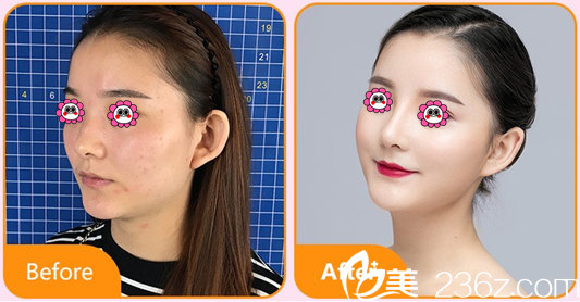 北京藝星慕昕BSK宮廷綜合隆鼻案例