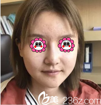 在北京藝星找連凱峰做面部吸脂前樣子 在北京藝星找連凱峰做面部吸脂前樣子