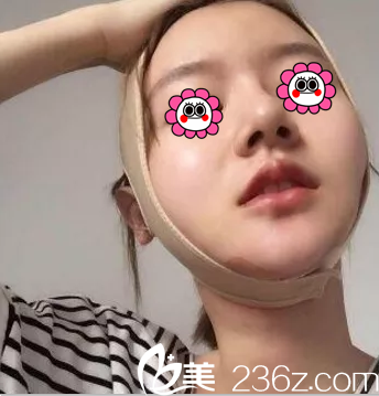 連凱峰醫(yī)生給我做面部吸脂第3天效果 連凱峰醫(yī)生給我做面部吸脂第3天效果