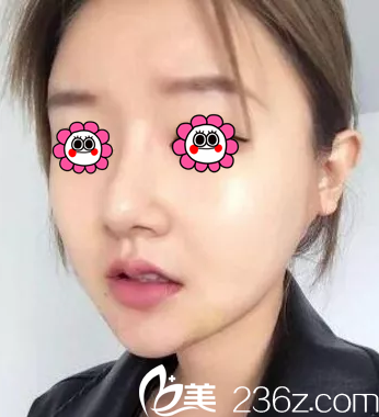 在北京藝星找連凱峰做面部吸脂第21天效果 在北京藝星找連凱峰做面部吸脂第21天效果