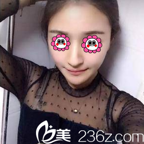 北京藝星連凱峰面部吸脂案例 北京藝星連凱峰面部吸脂案例