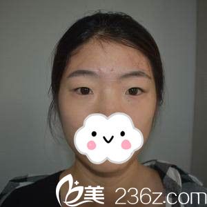 手術(shù)前的我 手術(shù)前的我