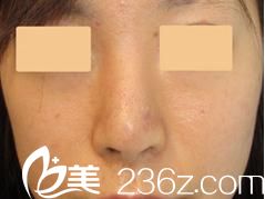 銀座紫羅蘭花美容形成外科醫(yī)院鼻部修復(fù)前 銀座紫羅蘭花美容形成外科醫(yī)院鼻部修復(fù)前