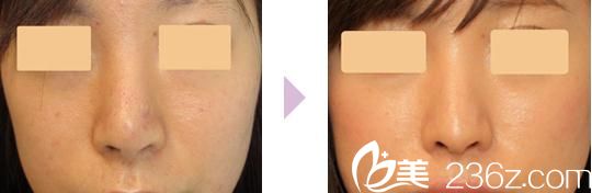 20190102_1546398623841143.jpg 手術(shù)前后對比.jpg