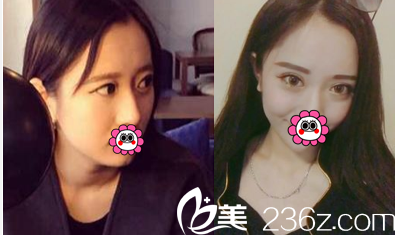 北京藝星<!--<i data=20240703-sp></i>-->謙醫(yī)生雙眼皮案例