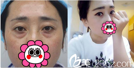 北京藝星<!--<i data=20240703-sp></i>-->謙醫(yī)生祛眼袋案例