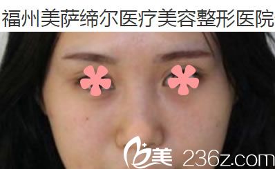 在福州美薩締爾隆鼻前的蒜頭鼻 在福州美薩締爾隆鼻前的蒜頭鼻