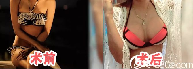 泰國PICHET Rodchareon整形醫(yī)院乳房增大手術(shù)<span style=