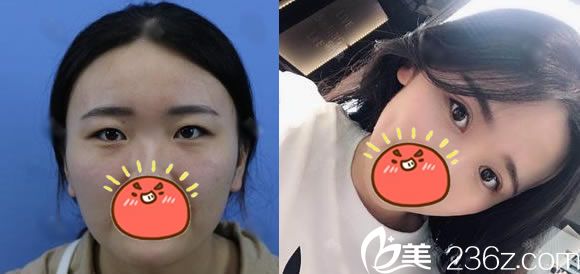 寧波美萊醫(yī)院陳富旺雙眼皮開眼角案例 寧波美萊醫(yī)院陳富旺雙眼皮開眼角案例