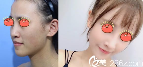 寧波美萊陳富旺鼻綜合隆鼻案例 寧波美萊陳富旺鼻綜合隆鼻案例