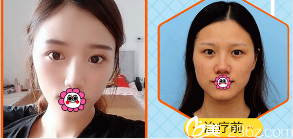 北京藝星王丹丹醫(yī)生美膚祛痘案例 北京藝星王丹丹醫(yī)生美膚祛痘案例