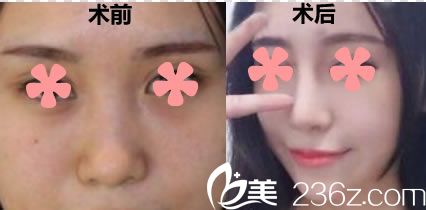 我得知耳軟骨和肋軟骨的區(qū)別后,還是去福州美薩締爾讓楊明玉做了膨體+耳軟骨隆鼻